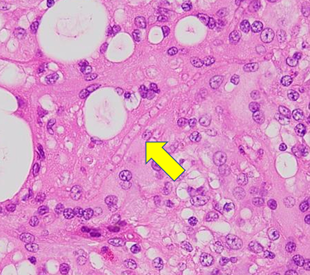 グリーンイグアナの肝臓の顕微鏡写真、連なった真菌（カビ）の菌糸（矢印）
